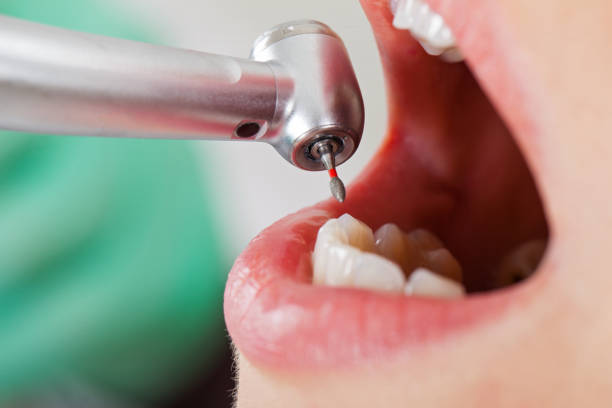 Best Emergency Dentist for Lost Fillings or Crowns in Merrifield, VA